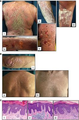 Identification of immunological patterns characterizing immune-related psoriasis reactions in oncological patients in therapy with anti-PD-1 checkpoint inhibitors